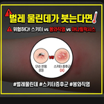 벌레 물린데가 붓는다면