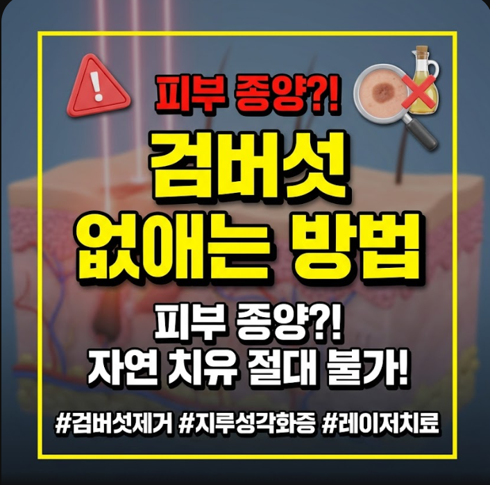 검버섯 없애는 방법