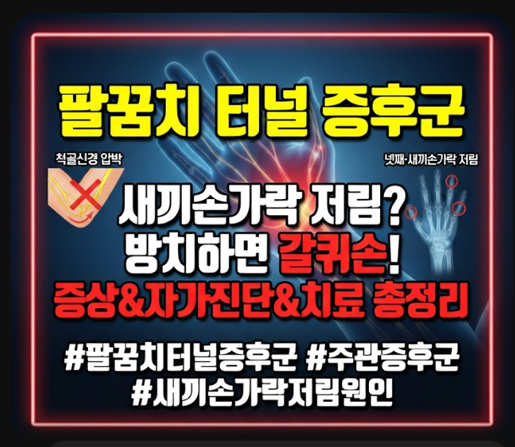 팔꿈치 터널 증후군